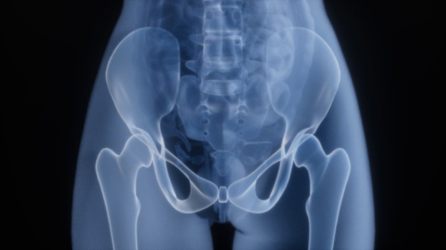 Sciatica