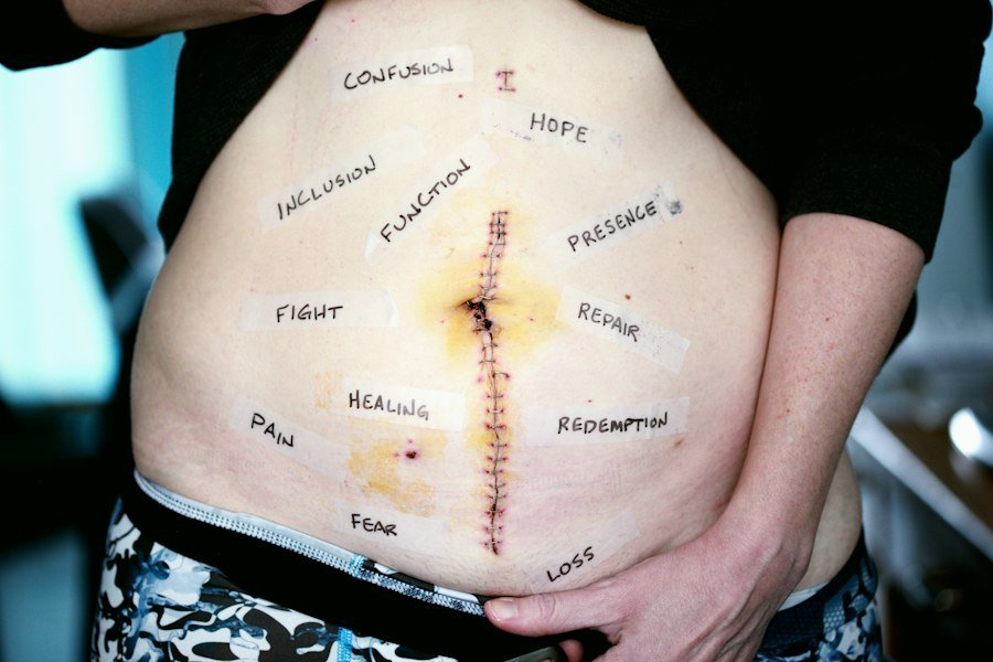 Photo Lumbar Decompression Surgery